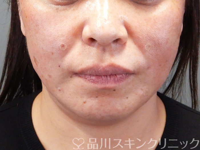 症例NO.69191のAFTER写真