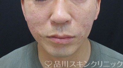 症例NO.70654のAFTER写真