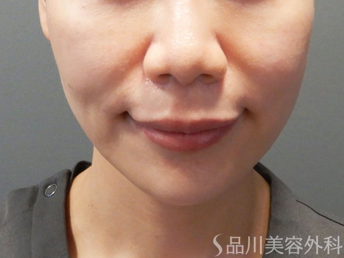 症例NO.70425のBEFORE写真
