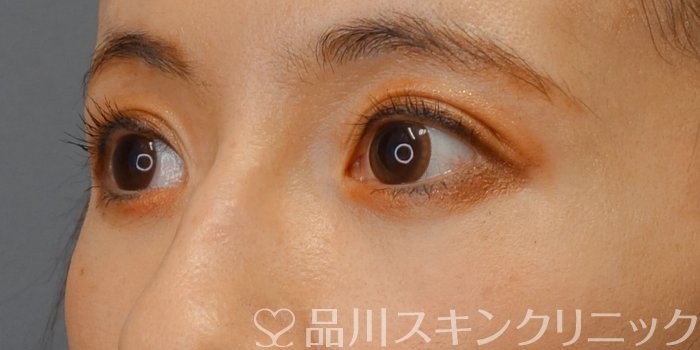 症例NO.74054のAFTER写真