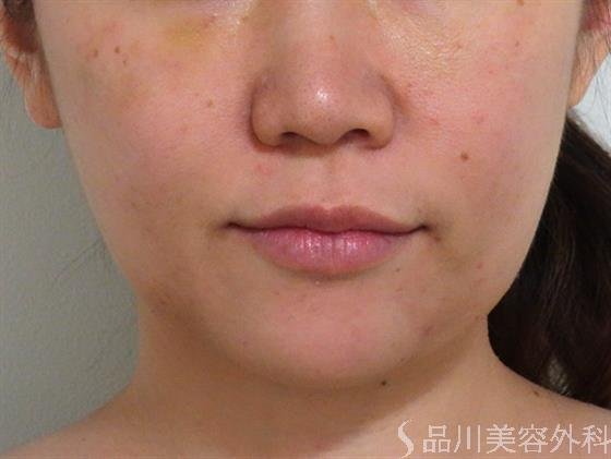 症例NO.36194のBEFORE写真
