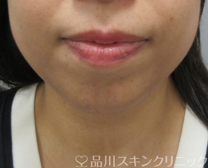 症例NO.74761のBEFORE写真