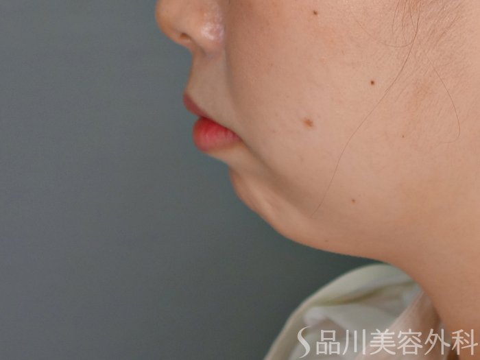 症例NO.69844のBEFORE写真