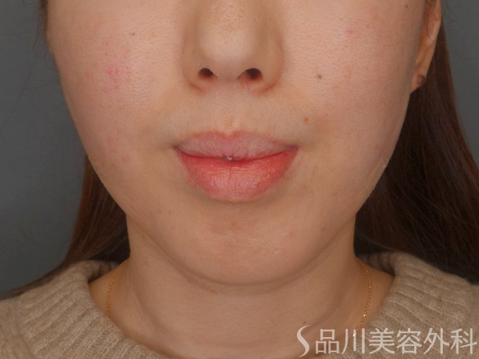 症例NO.72251のAFTER写真