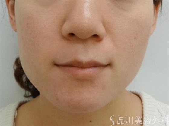 症例NO.20706のAFTER写真