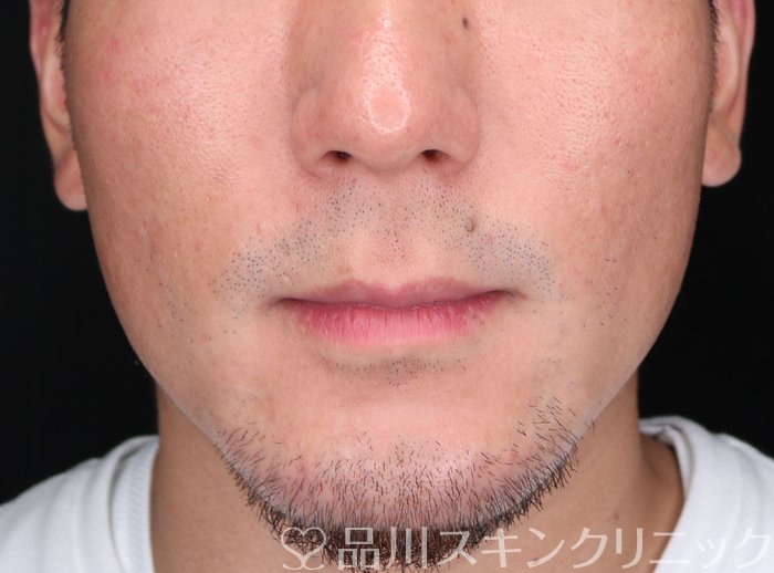 症例NO.69093のAFTER写真