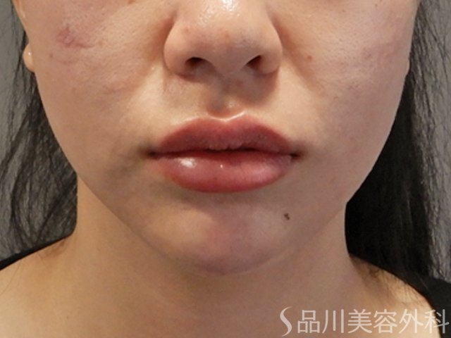 症例NO.71551のAFTER写真