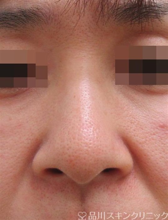 症例NO.29914のBEFORE写真