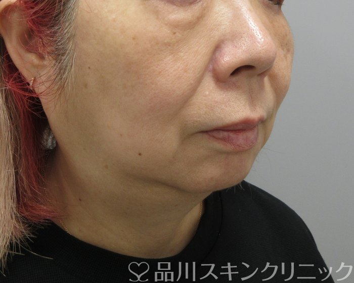 症例NO.73152のBEFORE写真