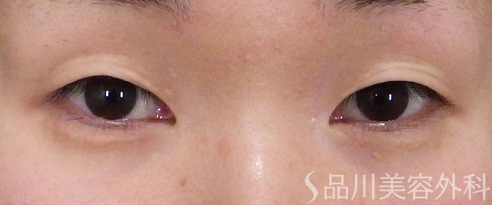 症例NO.72153のBEFORE写真