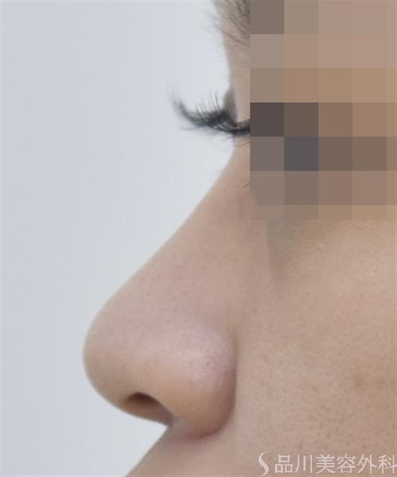 症例NO.50389のBEFORE写真