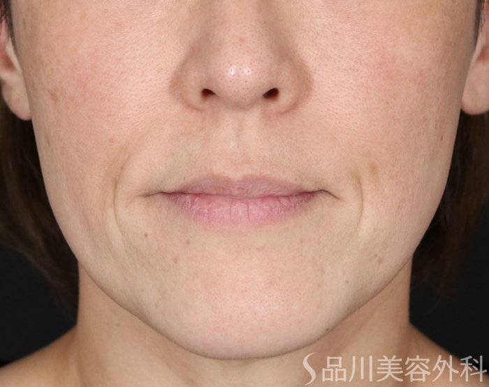 症例NO.71304のBEFORE写真