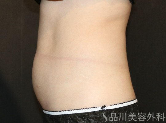 症例NO.73450のAFTER写真