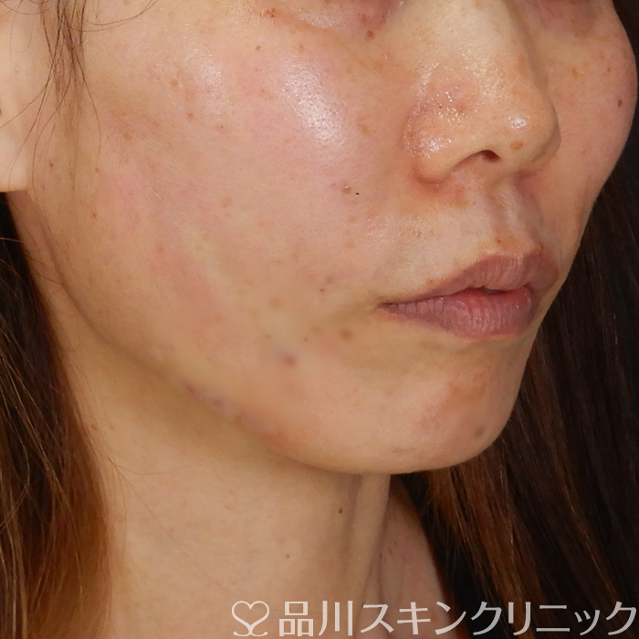 症例NO.63104のAFTER写真