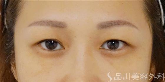 症例NO.36698のBEFORE写真