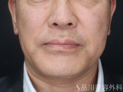 症例NO.73195のAFTER写真