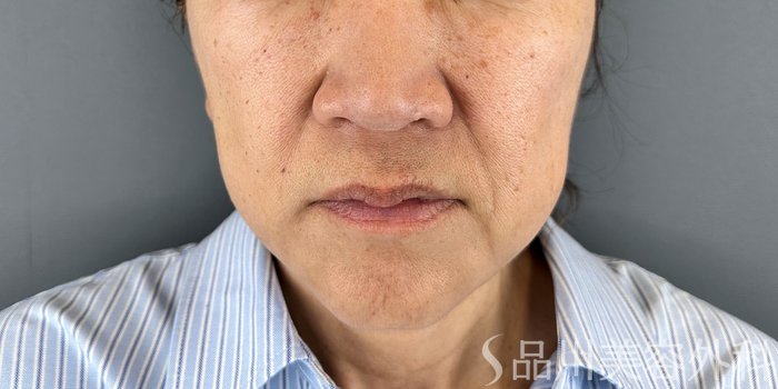 症例NO.70176のBEFORE写真