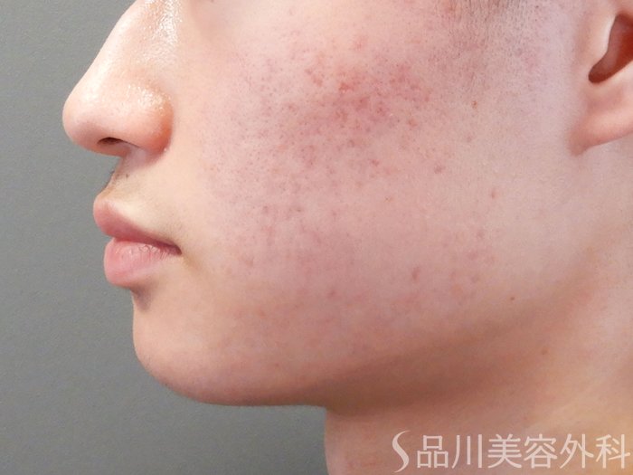 症例NO.70962のBEFORE写真
