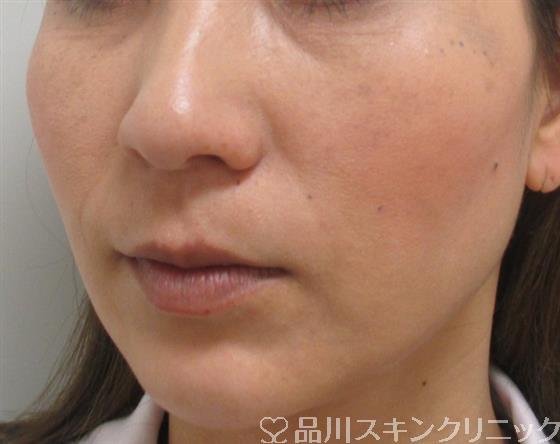症例NO.27302のAFTER写真