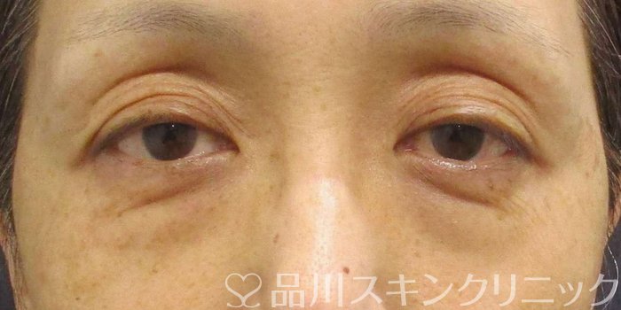 症例NO.75328のBEFORE写真
