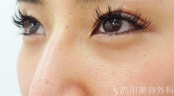 症例NO.39668のAFTER写真