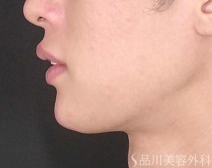 症例NO.65243のAFTER写真