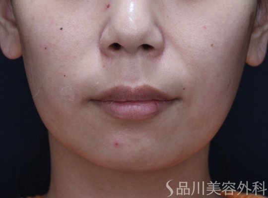 症例NO.73607のAFTER写真