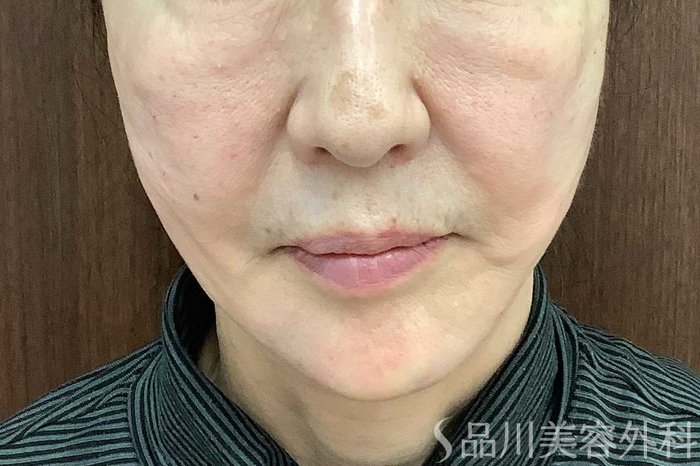 症例NO.62923のAFTER写真