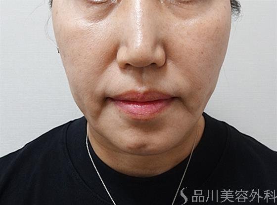 症例NO.61740のAFTER写真