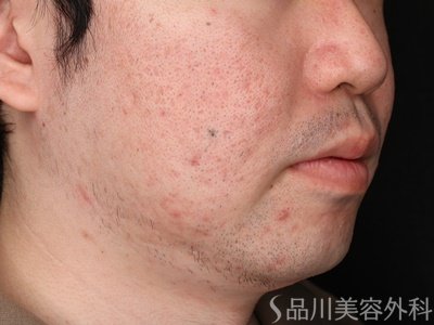 症例NO.71703のAFTER写真