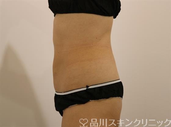 症例NO.43631のAFTER写真