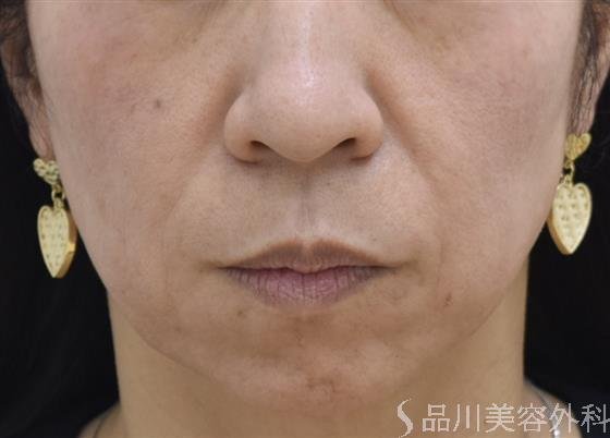 症例NO.44401のBEFORE写真