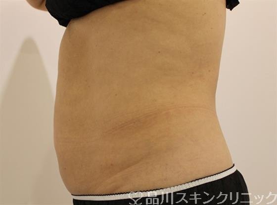 症例NO.46318のAFTER写真