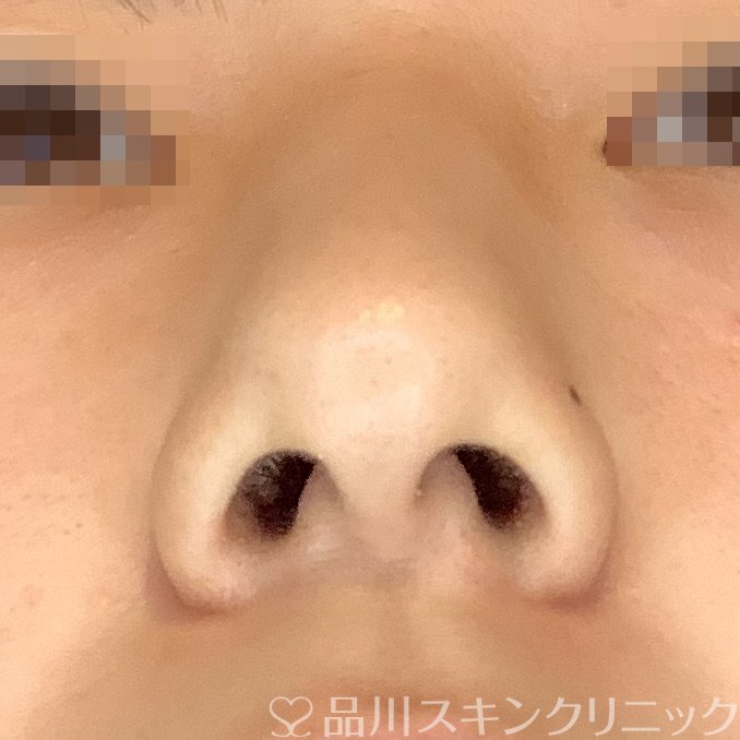 症例NO.69865のBEFORE写真