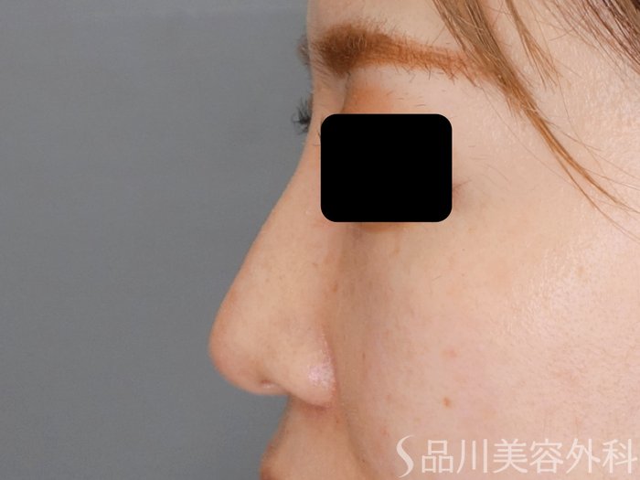 症例NO.70609のAFTER写真
