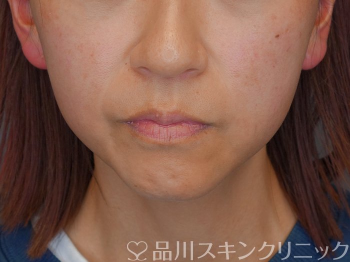 症例NO.72296のBEFORE写真