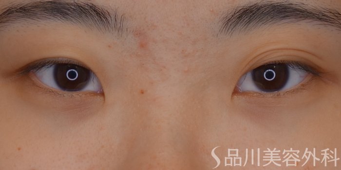 症例NO.65683のBEFORE写真