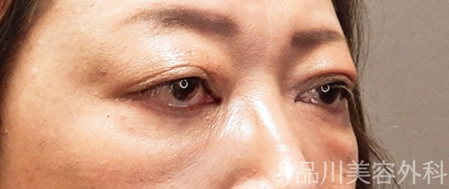 症例NO.69997のAFTER写真