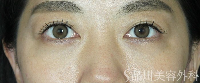 症例NO.62498のAFTER写真