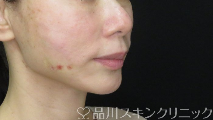 症例NO.72501のAFTER写真