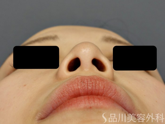 症例NO.74055のBEFORE写真