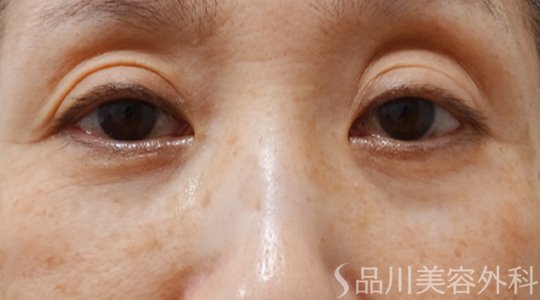 症例NO.69724のAFTER写真