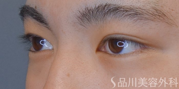 症例NO.73908のAFTER写真