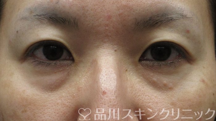 症例NO.71321のBEFORE写真