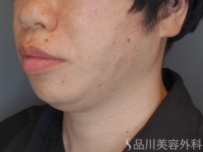 症例NO.70745のAFTER写真
