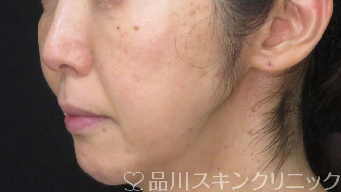 症例NO.71023のAFTER写真