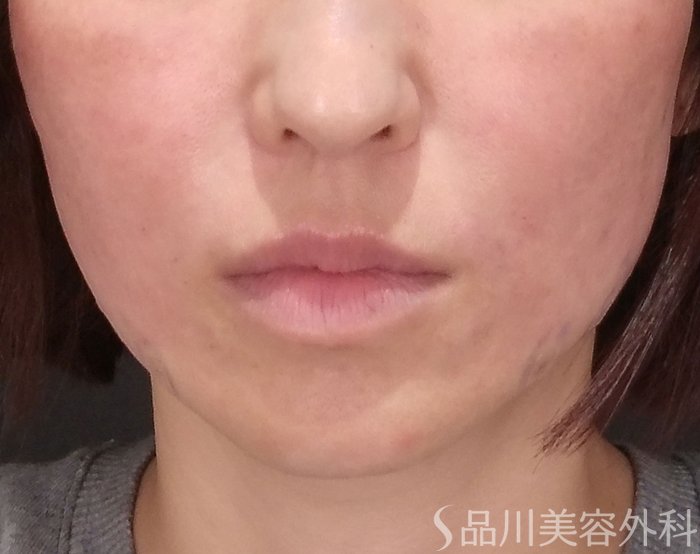 症例NO.69993のAFTER写真