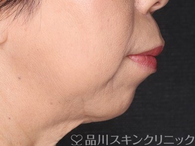 症例NO.74495のBEFORE写真