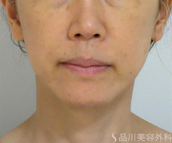 症例NO.44137のAFTER写真