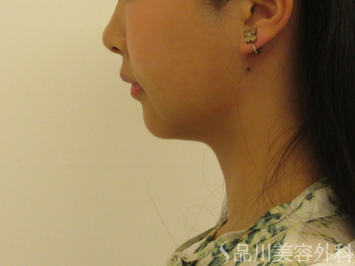 症例NO.74581のBEFORE写真